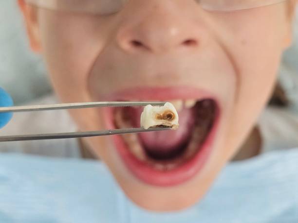Best Emergency Dental Care for Broken or Chipped Teeth in West Samoset, FL