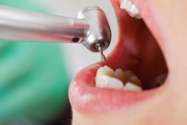 Best Emergency Treatment for Dental Infections or Abscesses in West Samoset, FL